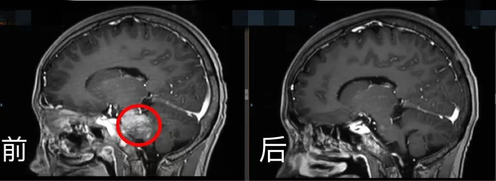 腦部CT前后對(duì)比。四川省腫瘤醫(yī)院供圖